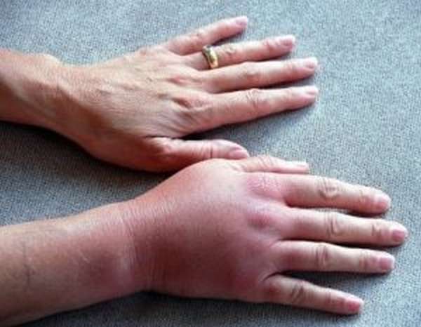 Симптомы и лечение синовита руки